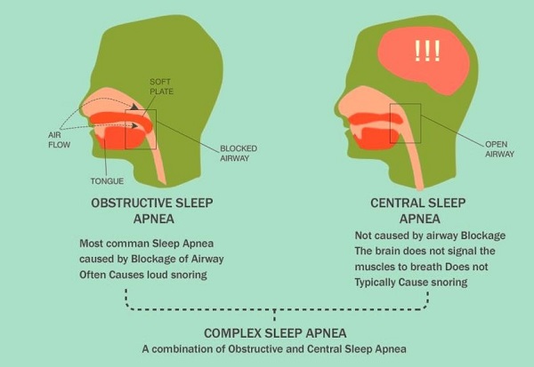 when-you-need-to-take-snoring-seriously-obstructive-sleep-apnea-facts